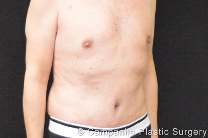 C.L.A.S.S. Tummy Tuck™ Patient Photo - Case 290 - after view-1