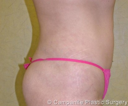 Liposuction Patient Photo - Case 72 - after view-0