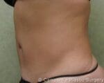 Tummy Tuck - Case 38 - After