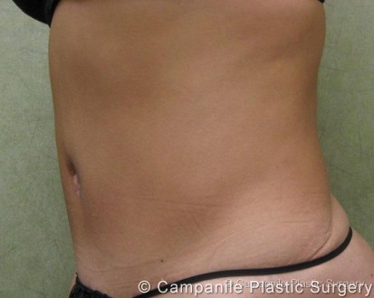 Tummy Tuck Patient Photo - Case 38 - after view