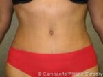 C.L.A.S.S.™ Tummy Tuck - Case 32 - After