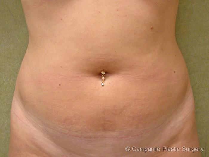 Liposuction Patient Photo - Case 63 - before view-1