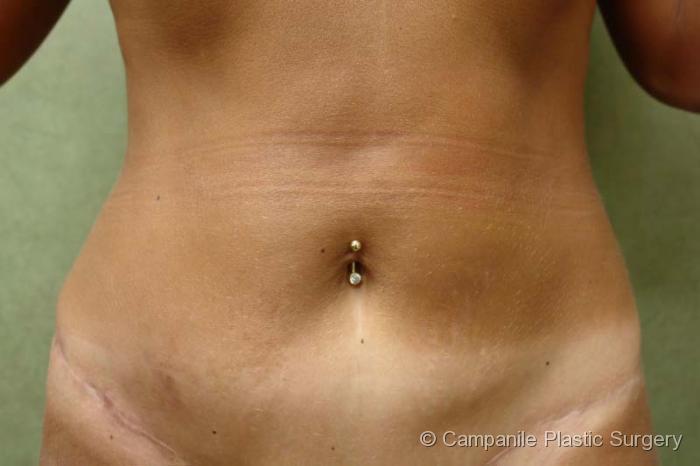 Tummy Tuck Revision Patient Photo - Case 50 - before view-