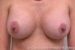Breast Augmentation - Case 97 - After