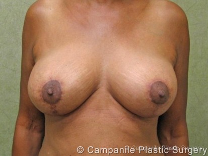 Breast Reduction Patient Photo - Case 162 - after view