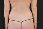 Liposuction - Case 299 - Before