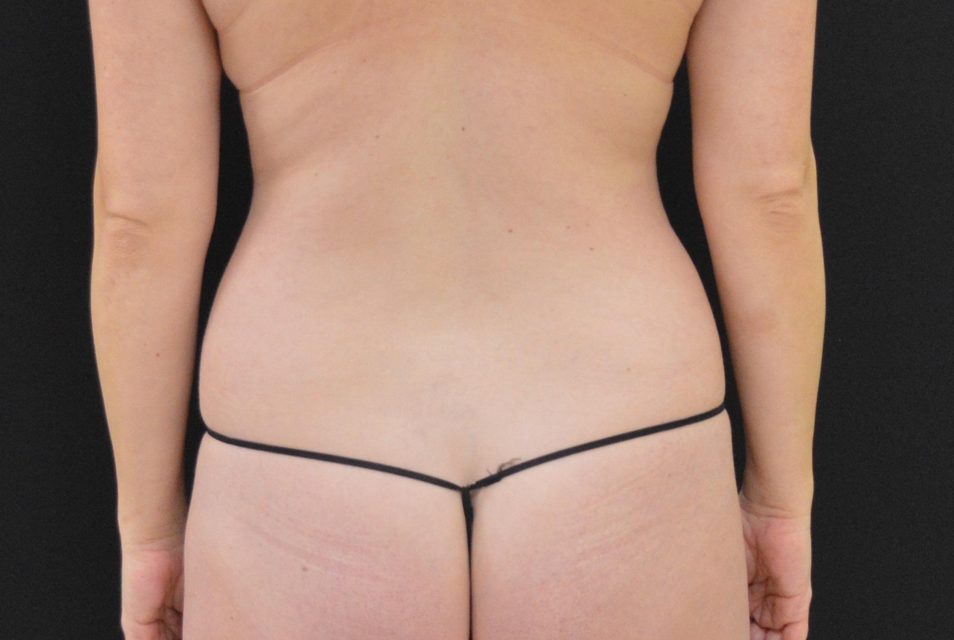 Liposuction Patient Photo - Case 299 - before view-