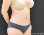 C.L.A.S.S.™ Tummy Tuck - Case 264 - After