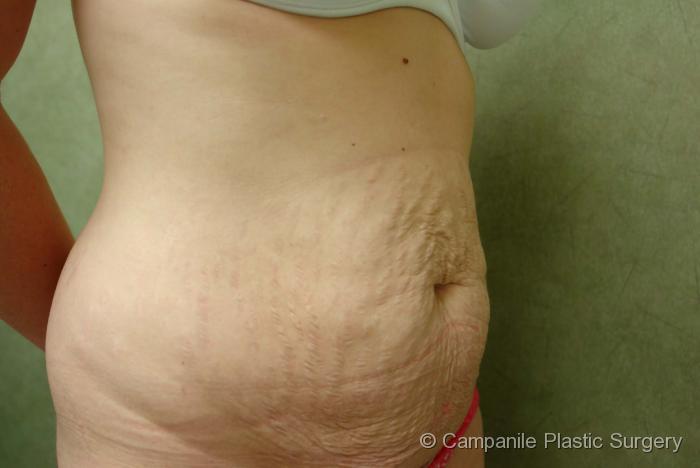 C.L.A.S.S.™ Tummy Tuck Patient Photo - Case 22 - before view-0
