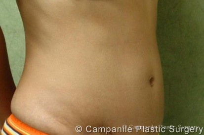 Tummy Tuck Patient Photo - Case 44 - after view-1