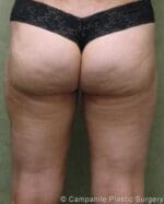Liposuction - Case 214 - After