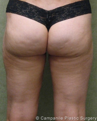 Liposuction Patient Photo - Case 214 - after view