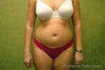 Liposuction - Case 56 - Before