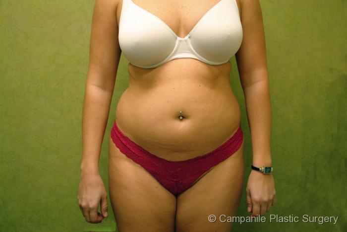 Liposuction Patient Photo - Case 56 - before view-