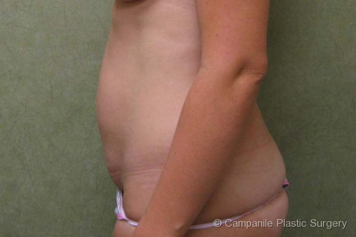 Mini Tummy Tuck Patient Photo - Case 46 - before view-1