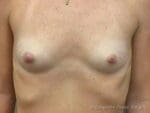 Breast Augmentation - Case 109 - Before