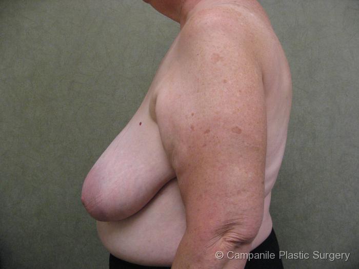 Breast Reduction Patient Photo - Case 172 - before view-1