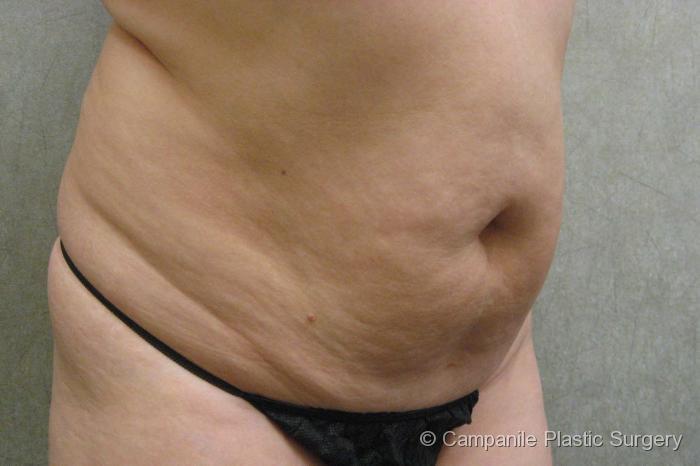 C.L.A.S.S.™ Tummy Tuck Patient Photo - Case 21 - before view-