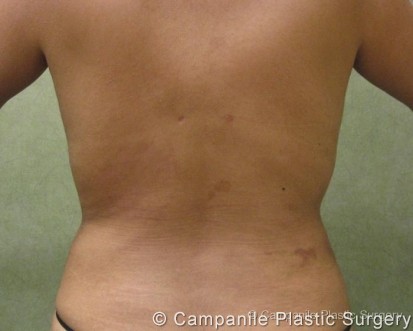 Liposuction Patient Photo - Case 69 - after view