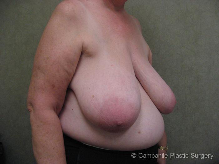 Breast Reduction Patient Photo - Case 172 - before view-