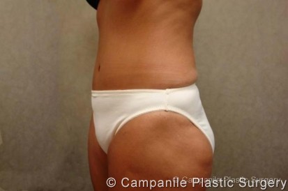 Tummy Tuck Revision Patient Photo - Case 50 - after view-1