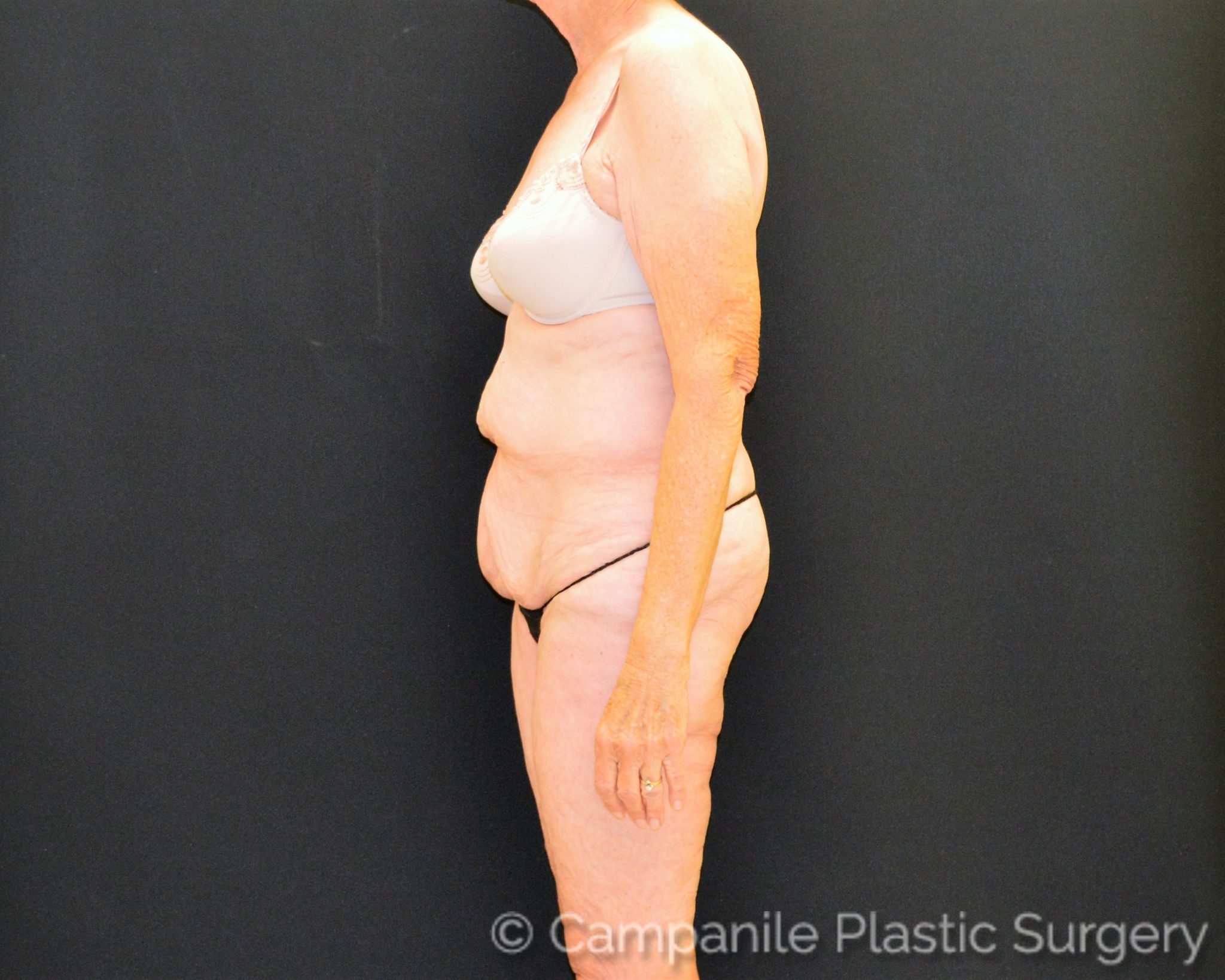 After Massive Weight Loss Patient Photo - Case 7787 - before view-