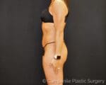 Liposuction - Case 7805 - After