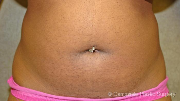 Liposuction Patient Photo - Case 60 - before view-