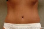 Tummy Tuck Revision - Case 50 - After