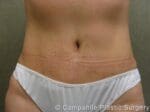 C.L.A.S.S.™ Tummy Tuck - Case 31 - After