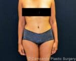 C.L.A.S.S.™ Tummy Tuck - Case 313 - After