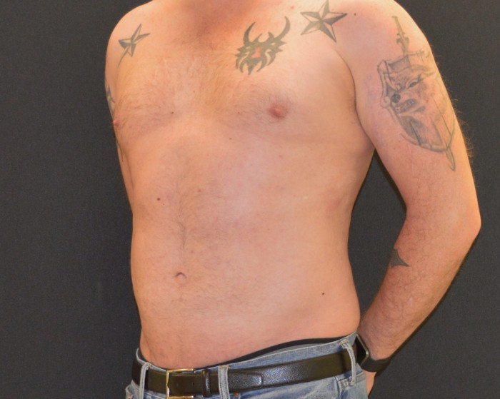 Liposuction Patient Photo - Case 316 - after view-1