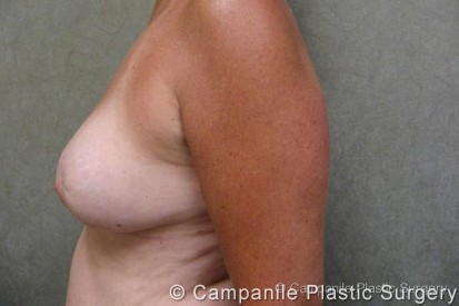 Breast Reduction Patient Photo - Case 169 - after view