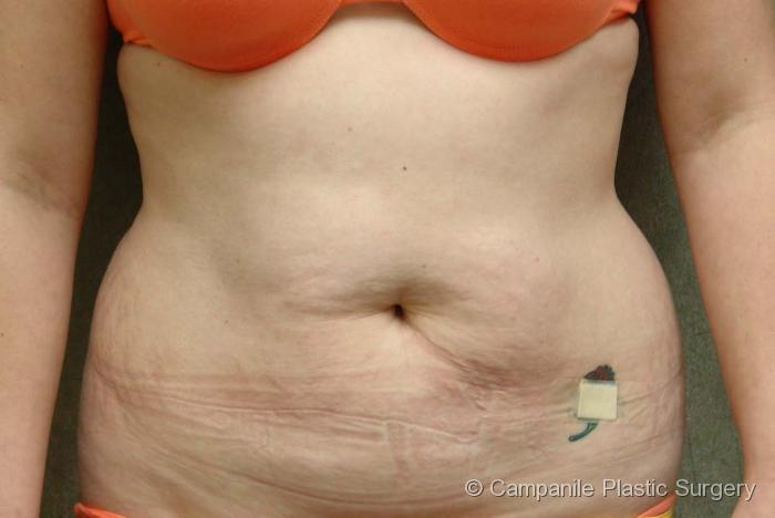 Tummy Tuck Patient Photo - Case 40 - before view-