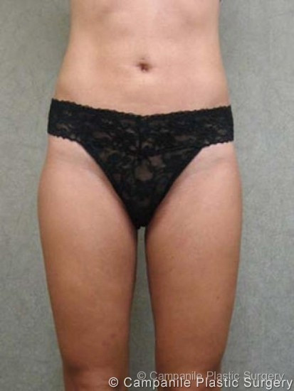 Liposuction Patient Photo - Case 67 - after view
