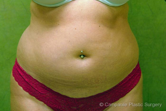 Liposuction Patient Photo - Case 56 - before view-1