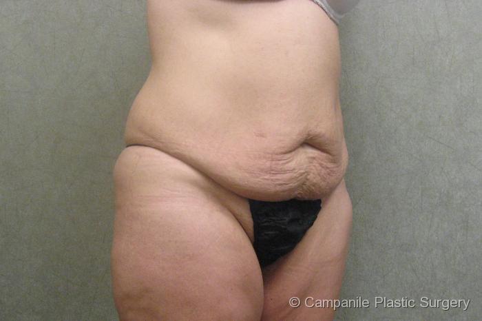 After Massive Weight Loss Patient Photo - Case 90 - before view-0