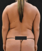 Liposuction - Case 217 - Before