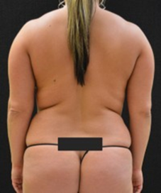 Liposuction Patient Photo - Case 217 - before view-