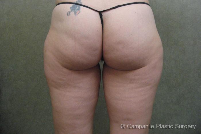 Liposuction Patient Photo - Case 71 - before view-