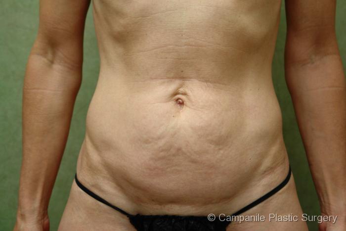 Tummy Tuck Patient Photo - Case 43 - before view-