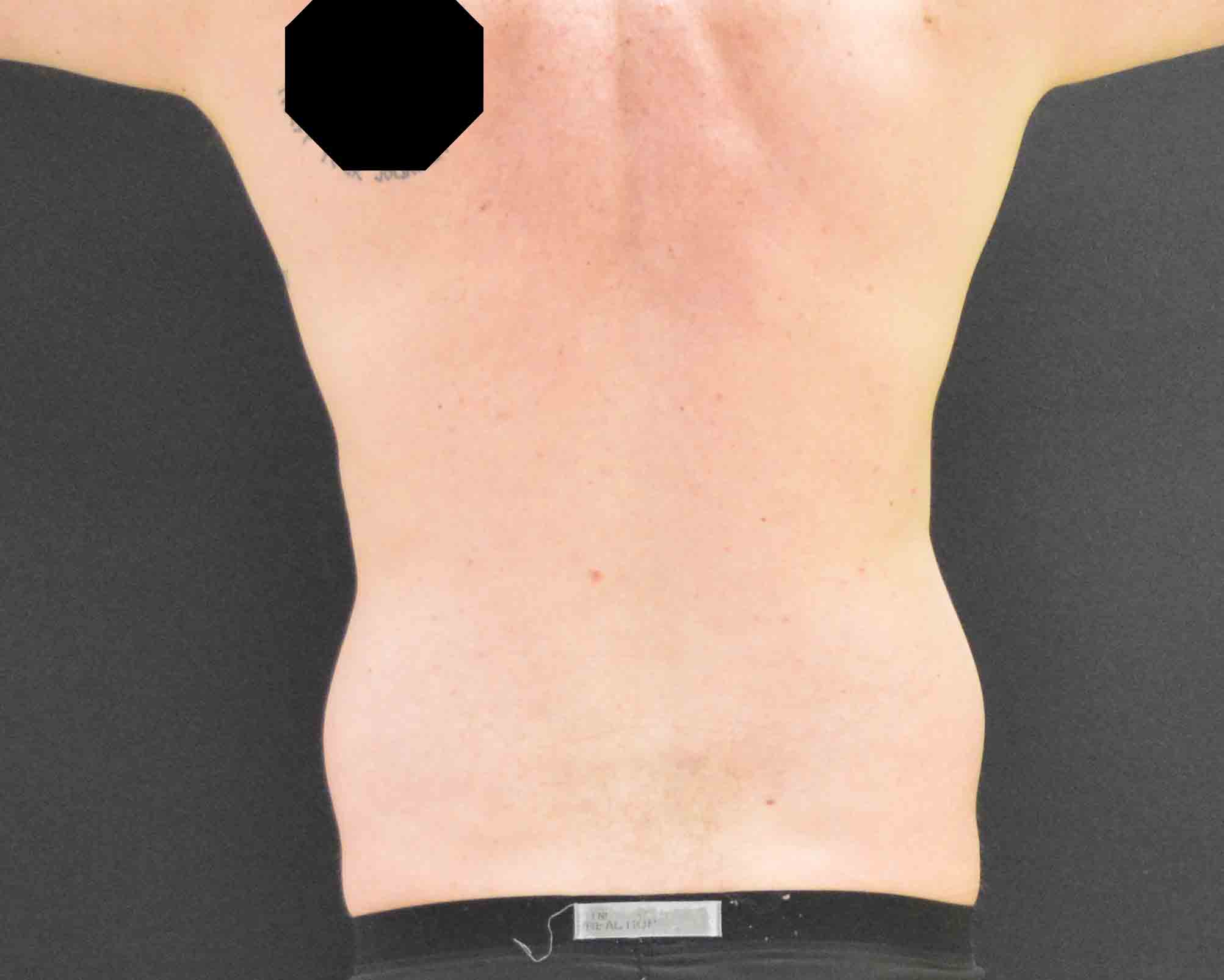 Liposuction - Case 315 - Before