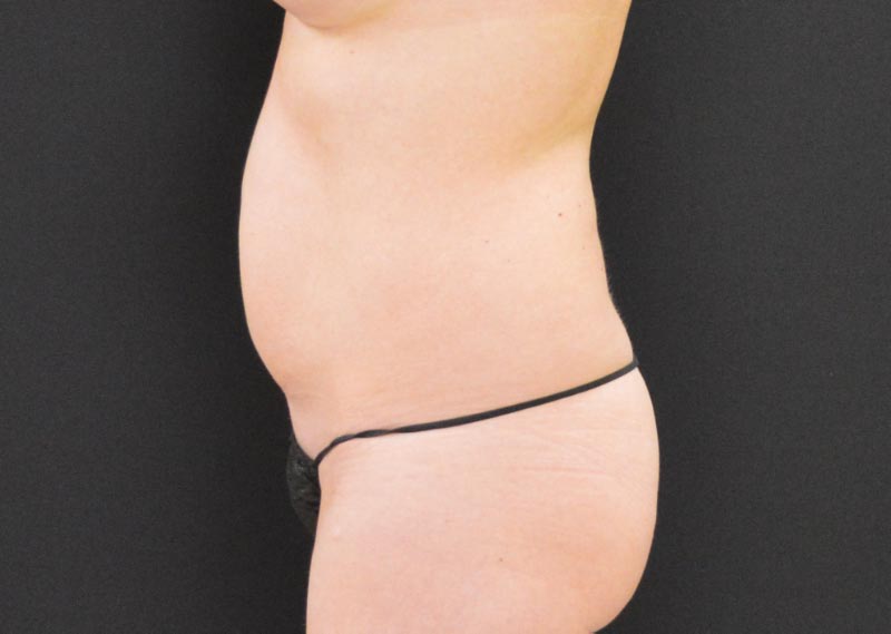 Tummy Tuck Patient Photo - Case 269 - before view-1