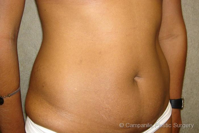 Tummy Tuck Patient Photo - Case 39 - before view-1