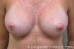 Breast Augmentation - Case 127 - After