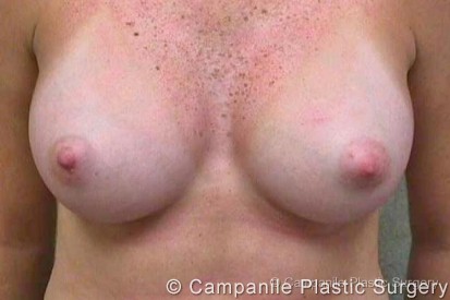 Breast Augmentation Patient Photo - Case 127 - after view