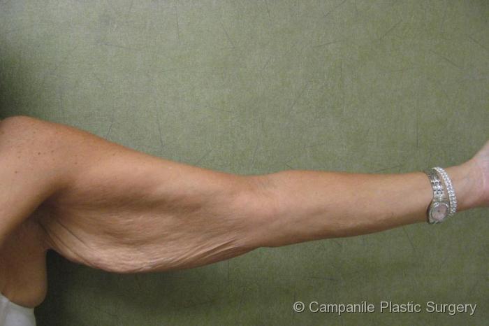 Arm Lift Patient Photo - Case 82 - before view-