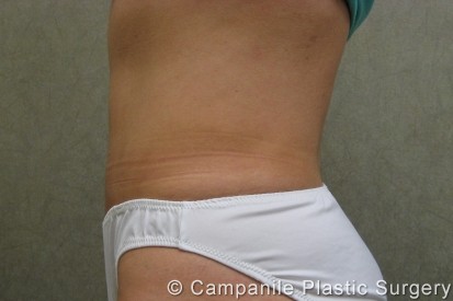 C.L.A.S.S.™ Tummy Tuck Patient Photo - Case 220 - after view-1