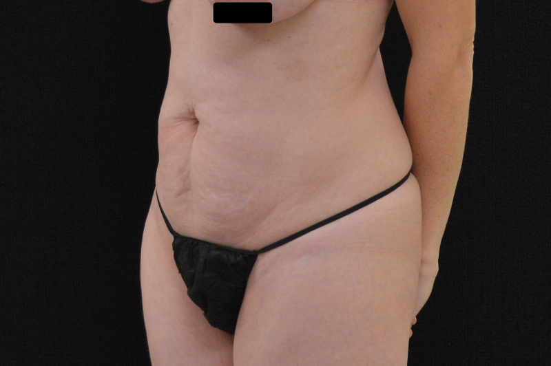C.L.A.S.S.™ Tummy Tuck Patient Photo - Case 240 - before view-