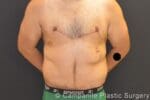After Massive Weight Loss - Case 291 - After